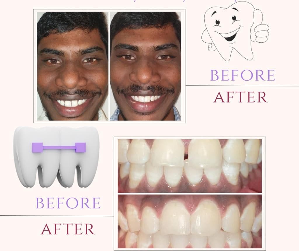 Laser Treatment